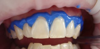 rehamedgorzow-2023-04 - wybielanie zębów-4.jpg